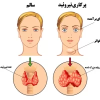 پرکاری تیروئید 1 Min