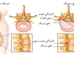 فتق دیسک یا سر خوردگی دیسک Min