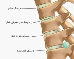 علائم فتق دیسک کمر Min