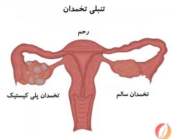 تخمدان1